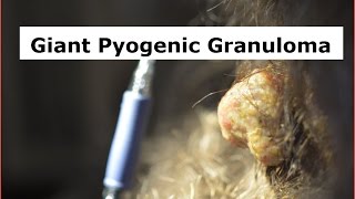 A Giant Pyogenic Granuloma [upl. by Aihtenyc]