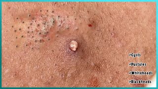 Big Cystic Acne Blackheads Extraction Blackheads amp Milia Whiteheads Removal Pimple Popping [upl. by Atived]