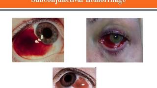 Subconjunctival Hemorrhage [upl. by Acsicnarf]