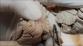 Neuroanatomy Dissections  Brainstem Third amp Fourth Ventricle Aqueduct of Sylvius [upl. by Renruojos81]