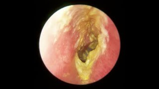 Otitis Externa [upl. by Teagan614]