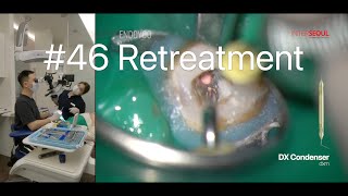 46  Retreatment of Mandibular Molar with Microscope 33 [upl. by Lemraj]