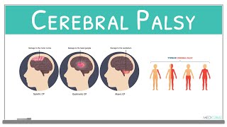 Cerebral Palsy classification causes signs and symptoms and treatment [upl. by Bigot]