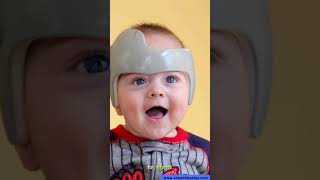 Infant Helmet Therapy Brachycephaly Flat Head Treatment UK [upl. by Rett]