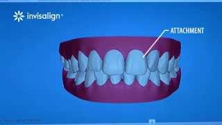 What You Can Expect During Invisalign Treatment [upl. by Domel]