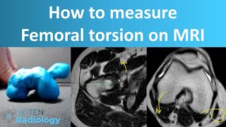 How to Measure Femoral Torsion on MRI [upl. by Lovmilla483]