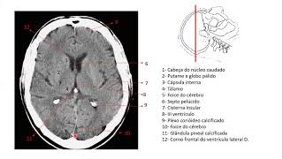 Encéfalo por imagens de tomografia [upl. by Durrace808]