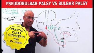 Pseudobulbar Palsy vs Bulbar Palsy [upl. by Carline]