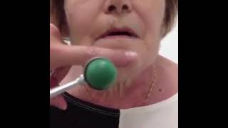 Exaggerated jaw jerk reflexPseudobulbar palsy [upl. by Bryana]