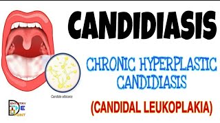 CANDIDIASIS  PRIMARY CHRONIC FORM  HYPERPLASTIC CANDIDIASIS OR CANDIDAL LEUKOPLAKIA [upl. by Eseneg750]