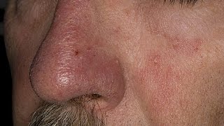 How to Treat Eczema on Face  Seborrheic Dermatitis Treatment  Face Eczema Treatment [upl. by Woothen]