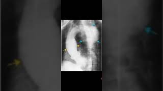 Syphilitic Aneurysm Aortography RadiologyAscending and Descending Aorta calcified Awerenes of all [upl. by Lirrad]