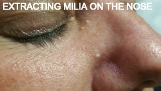 EXTRACTING MILIA ON THE NOSE [upl. by Huntingdon]