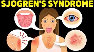 The Best Protocol for Sjogrens Syndrome [upl. by Fesuy287]