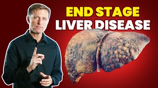 10 Signs of a Dying Liver End Stage Liver Disease [upl. by Thistle]