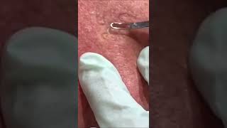 Thanksgiving Weekend Blackhead [upl. by Ahsenahs619]