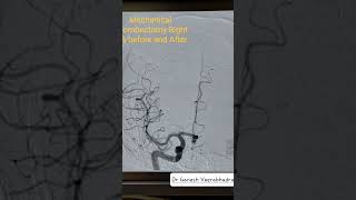 BRAIN STROKE IN GOLDEN HOUR  Mechanical ThrombectomyI BEFORE AFTER lOriginal DSA angiogram clip [upl. by Ahsiem]