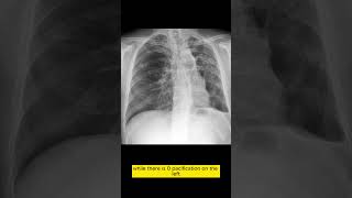 Decoding Chest Xray Bilateral Tuberculosislike Changes amp More chestxray [upl. by Jemena]