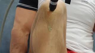 Osgood Schlatter treatment with shockwave [upl. by Aener310]