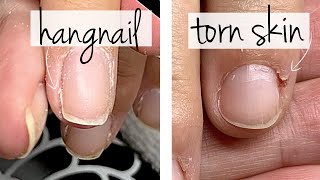 Hangnail or Torn Skin Do You Know the Difference [upl. by Ruvolo959]