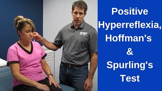 Positive Hoffmans Sign Hyperreflexia and Spurlings Test [upl. by Eahsed]