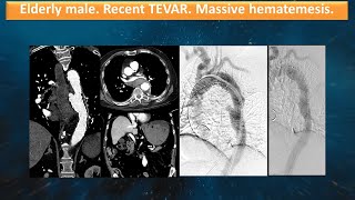 Elderly male Recent TEVAR Massive hematemesis [upl. by Tasiana865]