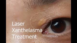 laser xanthelasma treatment [upl. by Eerol]