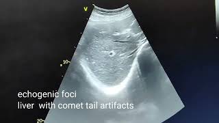 Pneumobilia due to gallbladder calculus ultrasound and color Doppler video [upl. by Lithea]