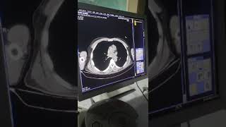 Distended small bowel loops related to ventral hernia which shows small bowel contents [upl. by Llenrac]