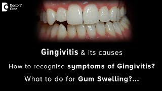 Gingivitis causes and symptoms  Gum swelling [upl. by Marguerite]