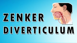 Zenkers Diverticulum [upl. by Anthe]