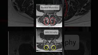 How to check Multifidus muscle in MRI [upl. by Nielson21]