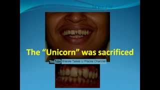 Extra tooth between front teeth  Fixed braces amp no teeth removed [upl. by Devaj29]