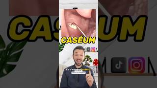 Qu’est ce que le Caséum  tonsil tonsilstones tonsilitis caseum breath breathing santé [upl. by Almat]