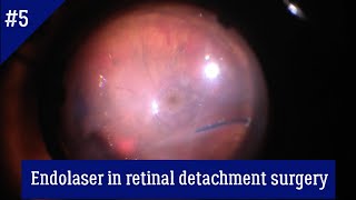 Endolaser in retinal detachment surgery [upl. by Seidnac]