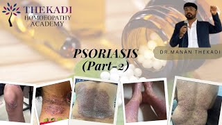 Homoeopathic medicines for psoriasis PSORIASIS PART  2 [upl. by Ledua720]