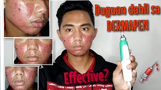 DERMAPEN BEFORE AND AFTER TREATMENT HONEST REVIEW Dermapen VS Dermaroller Dermapen Tutorial At Home [upl. by Wadesworth629]