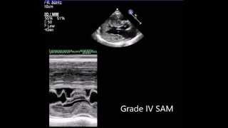 Echocardiographic Grading of Systolic Anterior Motion of the Mitral Valve [upl. by Manny]