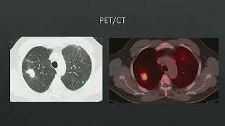 Pneumoconiosis [upl. by Leith580]