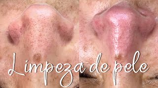 LIMPEZA DE PELE COM EXTRAÇÃO DE CRAVOS  KIT BIOAGE [upl. by Norat631]