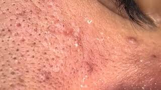 how to remove forehead pimples in one day  white blackheads on face  comedones treatment [upl. by Gnod750]