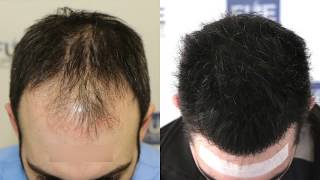 FUE Hair Transplant 3467  1000 grafts in NW  Class IV  A Dr Juan Couto  FUEXPERT CLINIC [upl. by Melony]