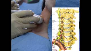 Stellate Ganglion Block for PTSD a Short Video [upl. by Ayanaj]