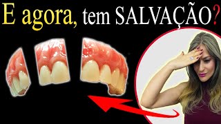 Sua PRÓTESE Total Dentadura QUEBROU tem CONSERTO Saiba o que fazer se sua Prótese caiu e quebrou [upl. by Aleel]