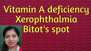 Xerophthalmia Vitamin A deficiency Bitots spot [upl. by Coletta]