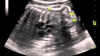 coarctation aorta query final [upl. by Christenson]