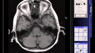 BRAIN MRI OLD INFARCTION [upl. by Dunham]