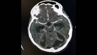 Otomastoiditis Sigmoid sinus thrombosis subdural empyema meningitis and obstructive hydrocephalus [upl. by Weil]