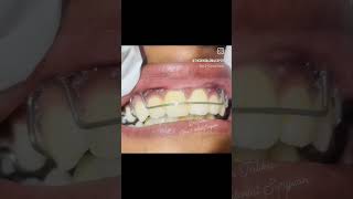 Teeth Retainer  Dental Retainers dentist aesthetic smile [upl. by Adnwahs]