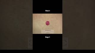 Merkel Cell Carcinoma Development Time Lapse  More Deadly Than Melanoma [upl. by Squire787]